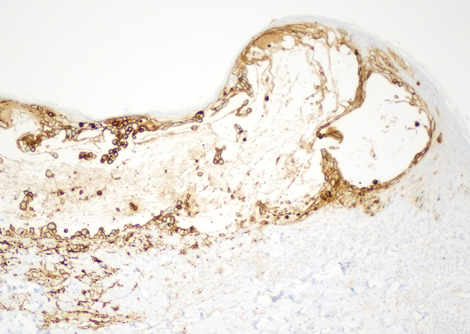 Immunostain for varicella-zoster virus was positive (original magnification ×100).