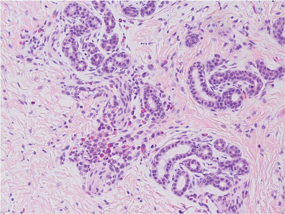 A punch biopsy demonstrated a periadnexal infiltrate with eosinophils (mature and immature), neutrophils, and macrophages in the deep dermis (H&E, original magnification ×200).