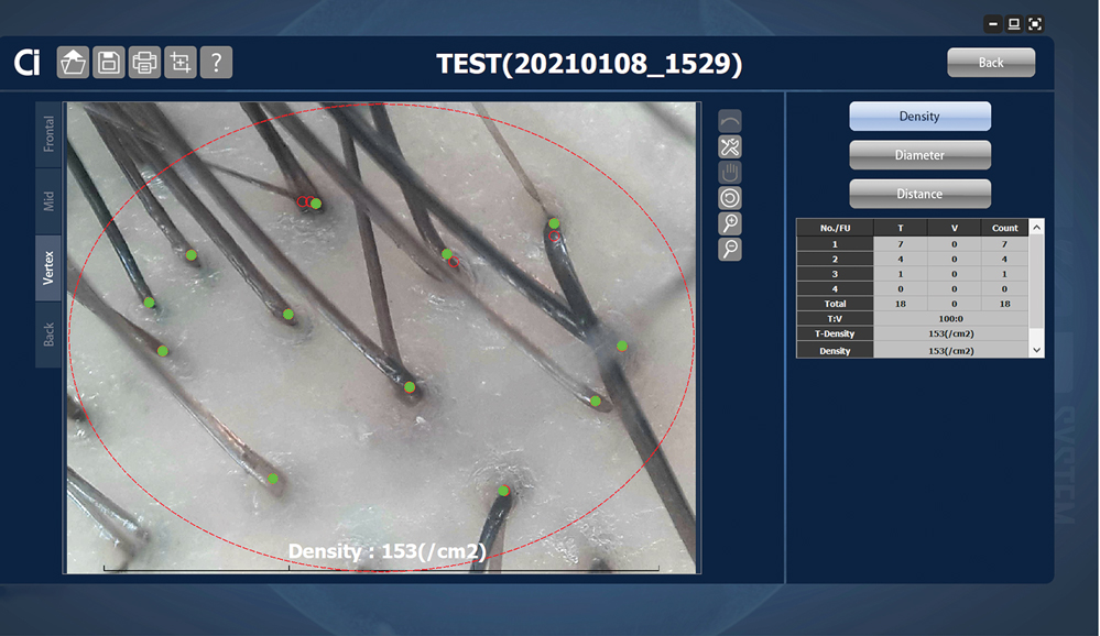 Hair analysis software accompanying videodermoscopy assists in calculations of hair count, follicular density, follicular diameter, and interfollicular distance.