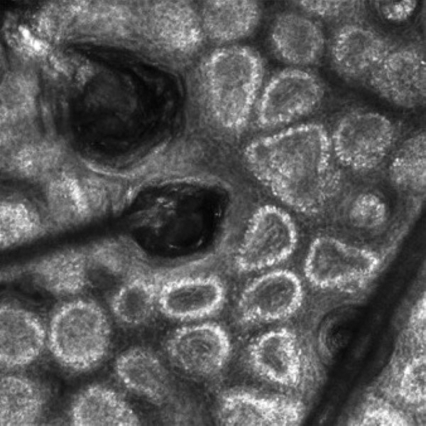 Distinguishable structures on reflectance confocal microscopy (RCM) images include individual keratinocytes, melanocytes, inflammatory cells, hair follicles, blood vessels, fibroblasts, and collagen.