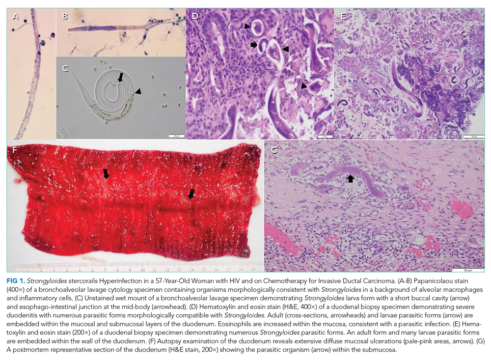 Strongyloides stercoralis Hyperinfection in a 57-Year-Old Woman with HIV and on Chemotherapy for Invasive Ductal Carcinoma