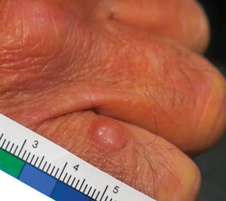 A lesion of concern on the fourth digit of the dorsal aspect of the right hand that initially was evaluated via teledermatology and later was diagnosed as Merkel cell carcinoma (patient 1).