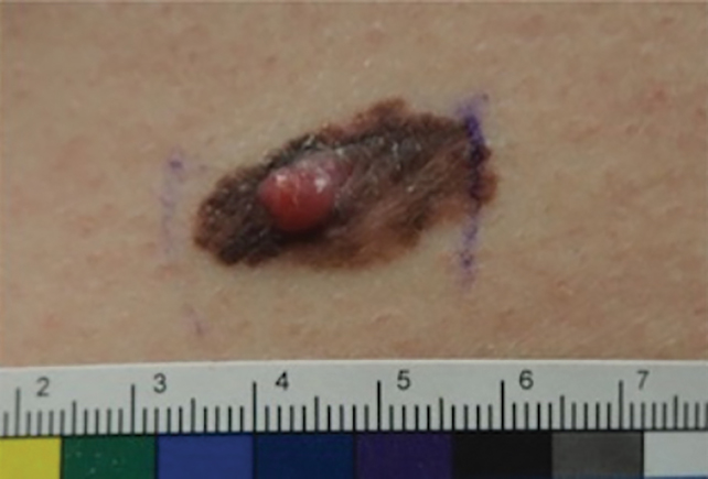 A lesion of concern on the left flank that initially was evaluated via teledermatology and later was diagnosed as a pT3b malignant melanoma (patient 2).