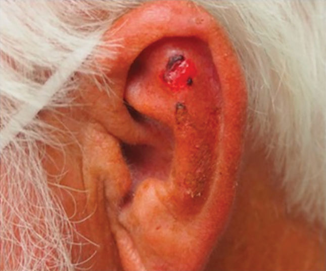 A lesion of concern on the left ear that initially was evaluated via teledermatology and later was diagnosed as atypical fibroxanthoma (patient 3).