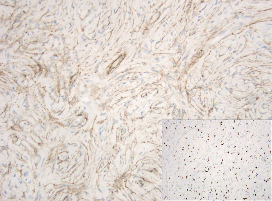 Immunohistochemical staining for epithelial membrane antigen was positive in the perineural cells (original magnification ×200) with the neural cells staining positive for SRY-box transcription factor 10 (inset, original magnification ×200).