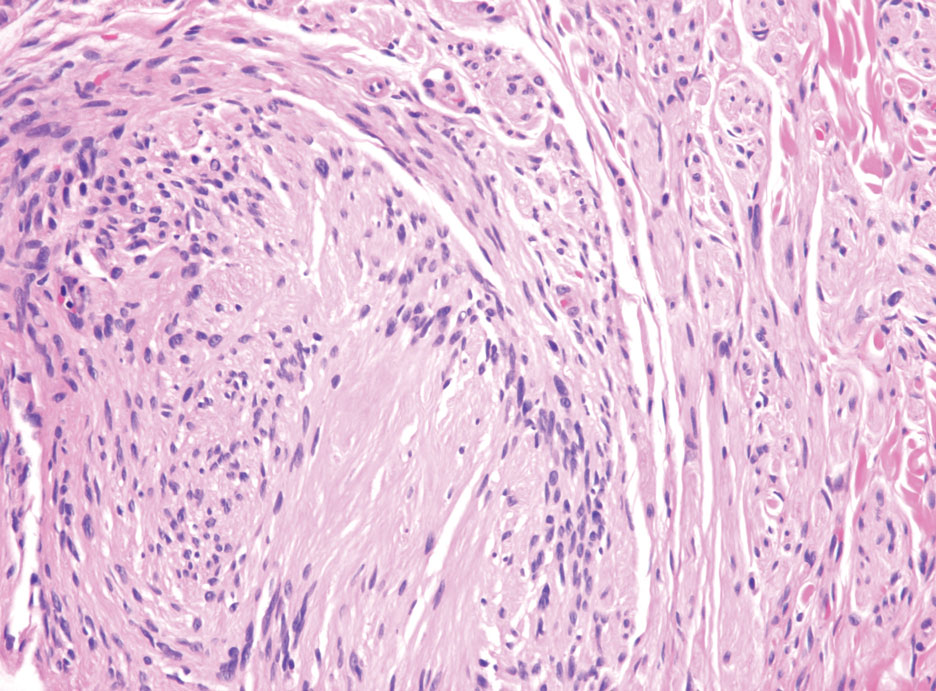 Schwannoma. Spindled Schwann cells with nuclear palisading consistent with Verocay body formation (H&E, original magnification ×200).
