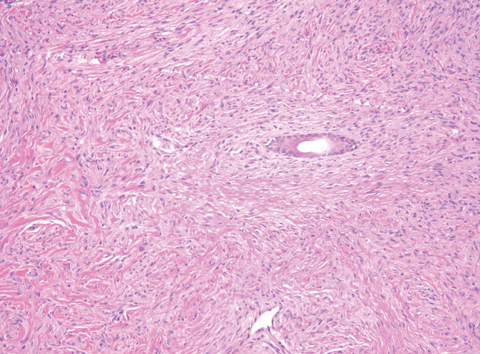 Desmoplastic melanoma. Cytologically atypical spindle cells infiltrating between collagen and around a hair follicle (H&E, original magnification ×100).