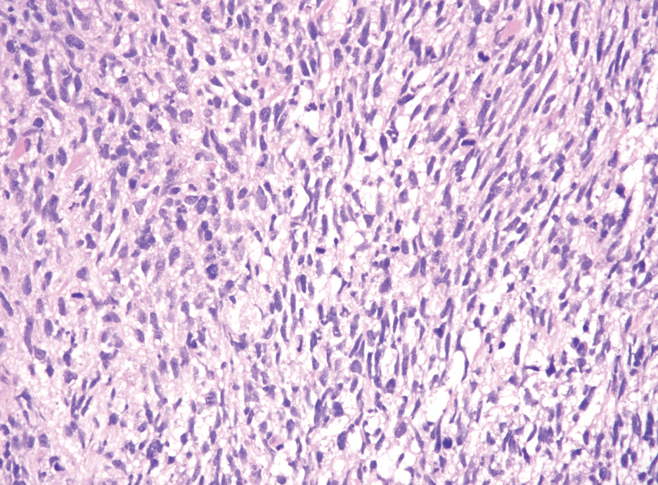 Malignant peripheral nerve sheath tumor. Cellular proliferation of cytologically atypical spindle cells with nuclear pleomorphism and mitotic activity (H&E, original magnification ×200).
