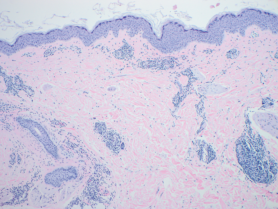 Figurate erythema demonstrates a superficial and deep perivascular lymphocytic infiltrate (H&E, original magnification ×10).