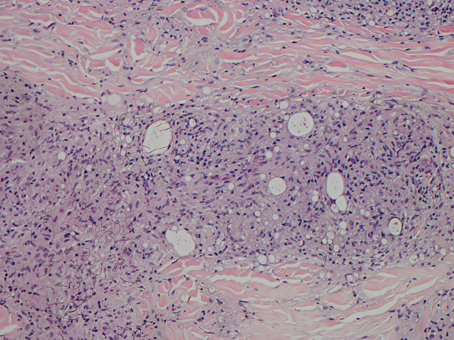 In lepromatous leprosy, diffuse histiocytes with globi are seen (H&E, original magnification ×20).