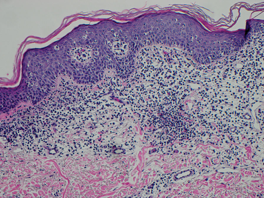 In patch-stage mycosis fungoides, atypical lymphocytes migrating from the dermis to the epidermis, consistent with epidermotropism, are seen (H&E, original magnification ×20).