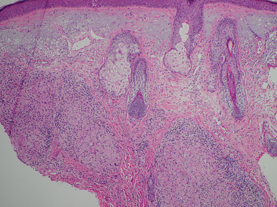 In sarcoidosis, epithelioid histiocytes form granulomas with minimal surrounding lymphocytic infiltrate (H&E, original magnification ×10).