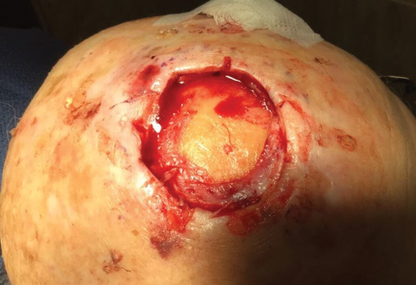 A deep scalp defect devoid of periosteum following Mohs micrographic surgery in an elderly patient with immobile adjacent tissue and multiple comorbidities.