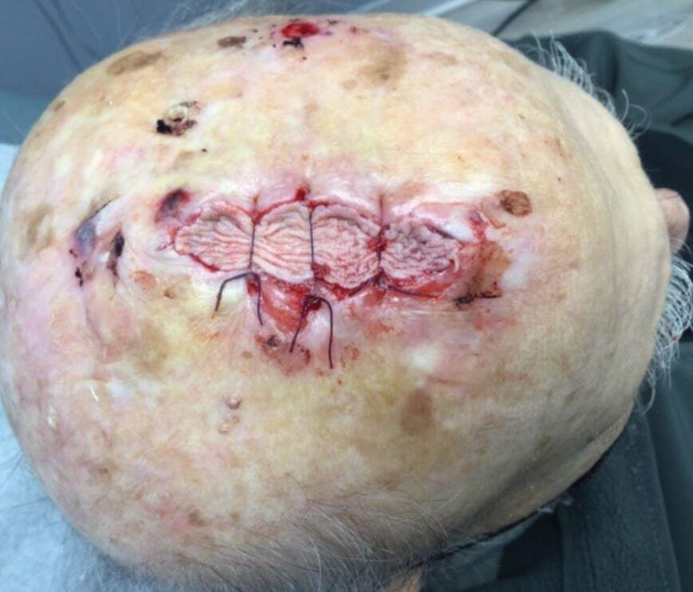 Pulley guiding sutures (3-0 polyglactin 910) decrease the size of the defect and secure a cadaveric split-thickness skin graft over the remaining exposed periosteum.