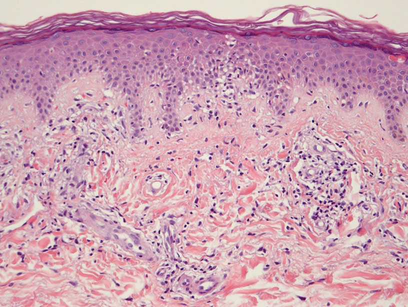 Histopathology of pigmented purpuric dermatoses