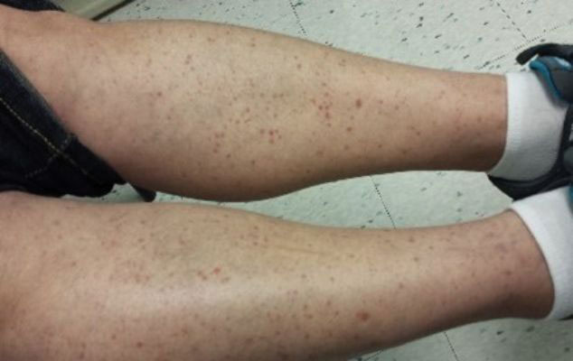 Palpable purpura of the lower extremities with nonblanching, dusky, erythematous papules in a patient with leukocytoclastic vasculitis.