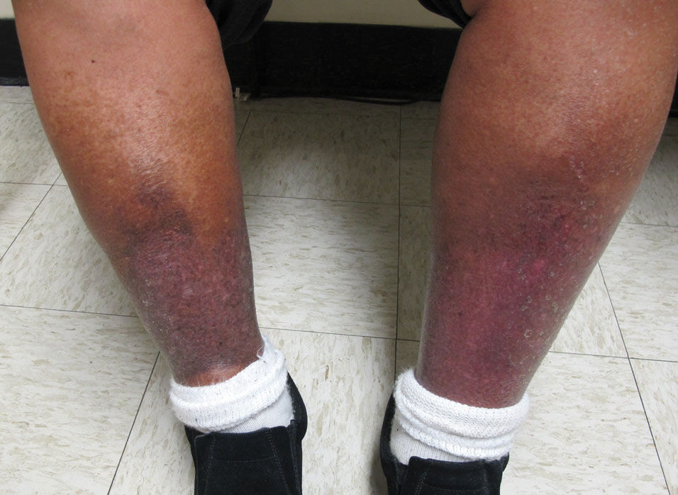 Stasis dermatitis with hyperpigmentation, induration, and edema of the legs.