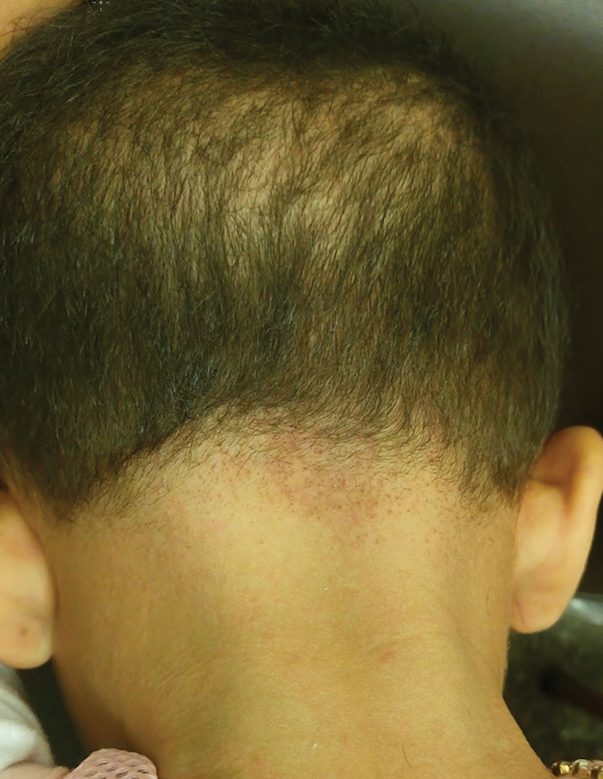 Sparse Hair on the Scalp | MDedge Dermatology