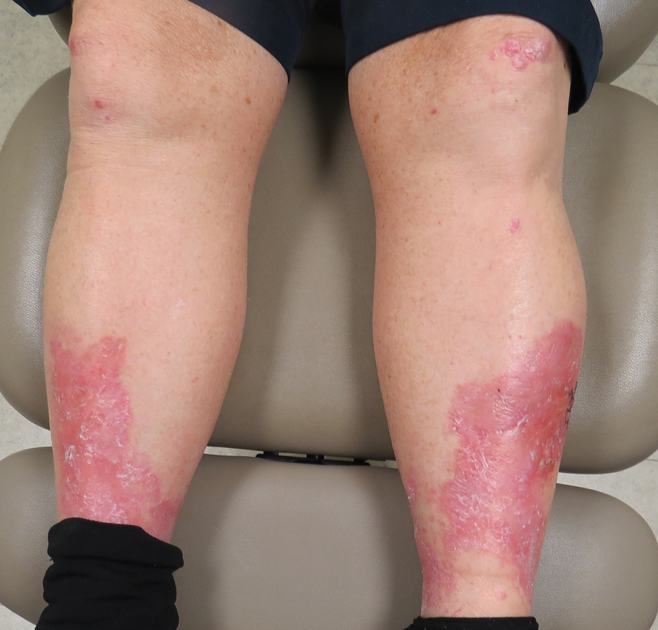 Erythema, Blisters, and Scars on the Elbows, Knees, and Legs