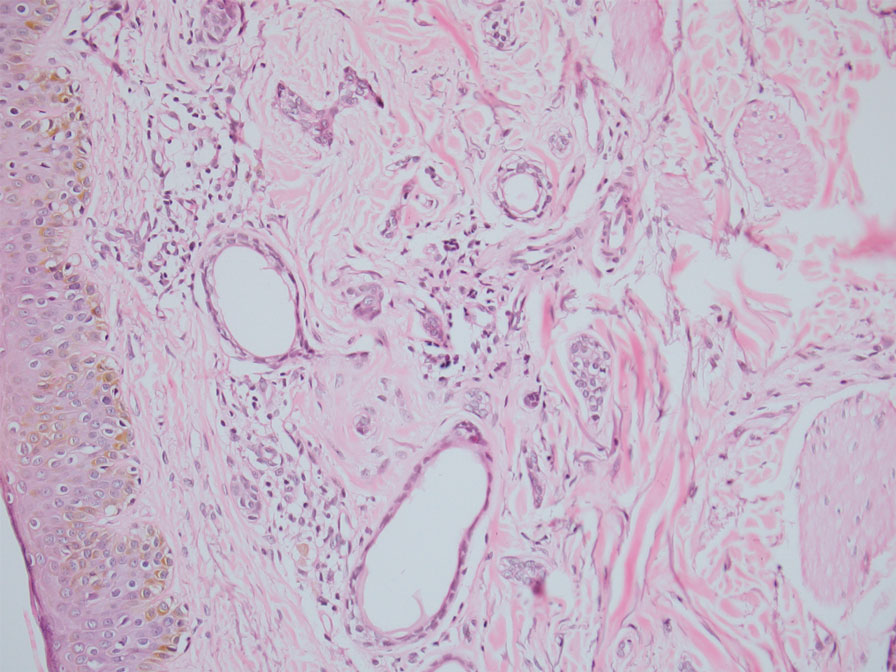 Biopsy of a neck lesion showed a well-circumscribed tumor in the dermis composed of varying size tubules, which were lined by cuboidal cells with round to vesicular nuclei and eosinophilic cytoplasm, characteristic of syringoma