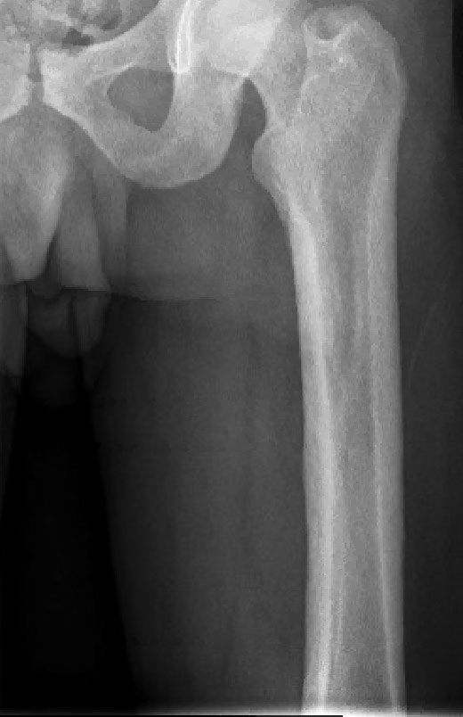 Radiography of the left femur demonstrated diffuse cortical thickening