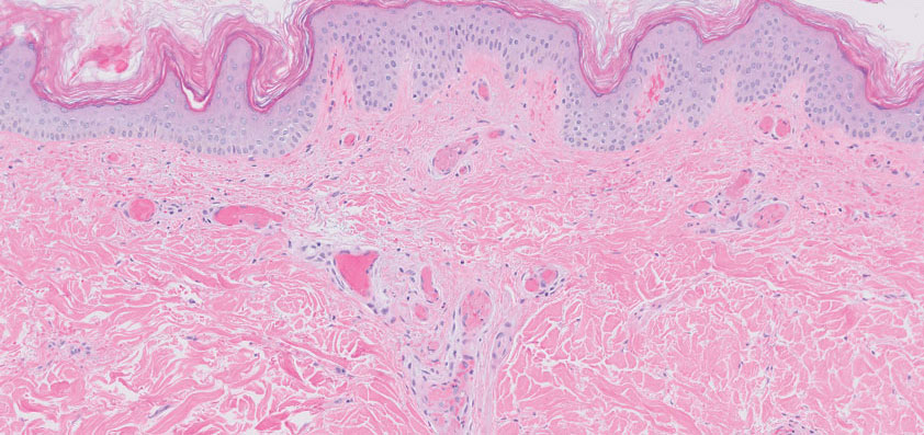 Occlusion of small-caliber dermal blood vessels by homogenous eosinophilic hyaline material (H&E, original magnification ×20).