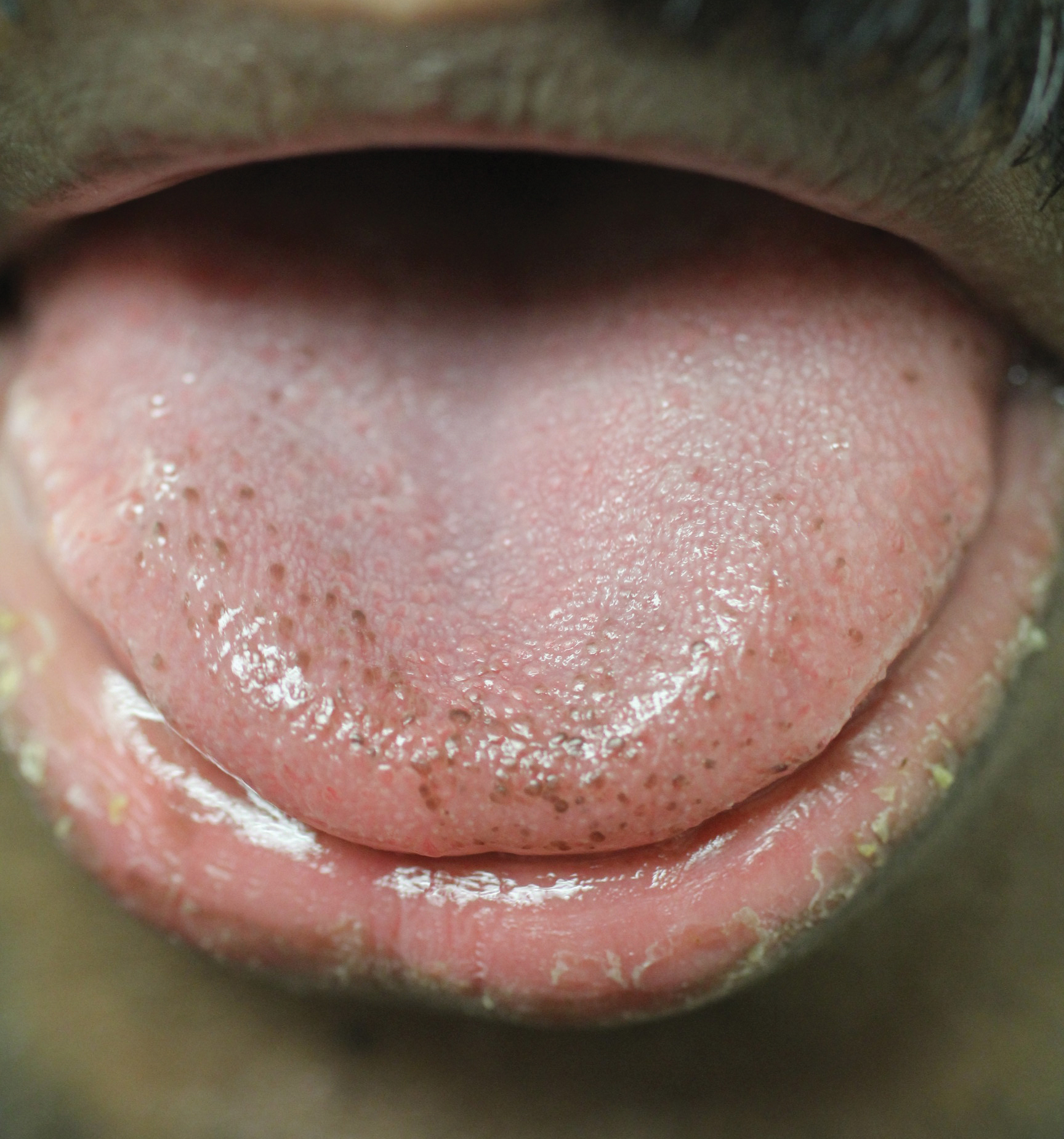 papillae under tongue spray de parazit