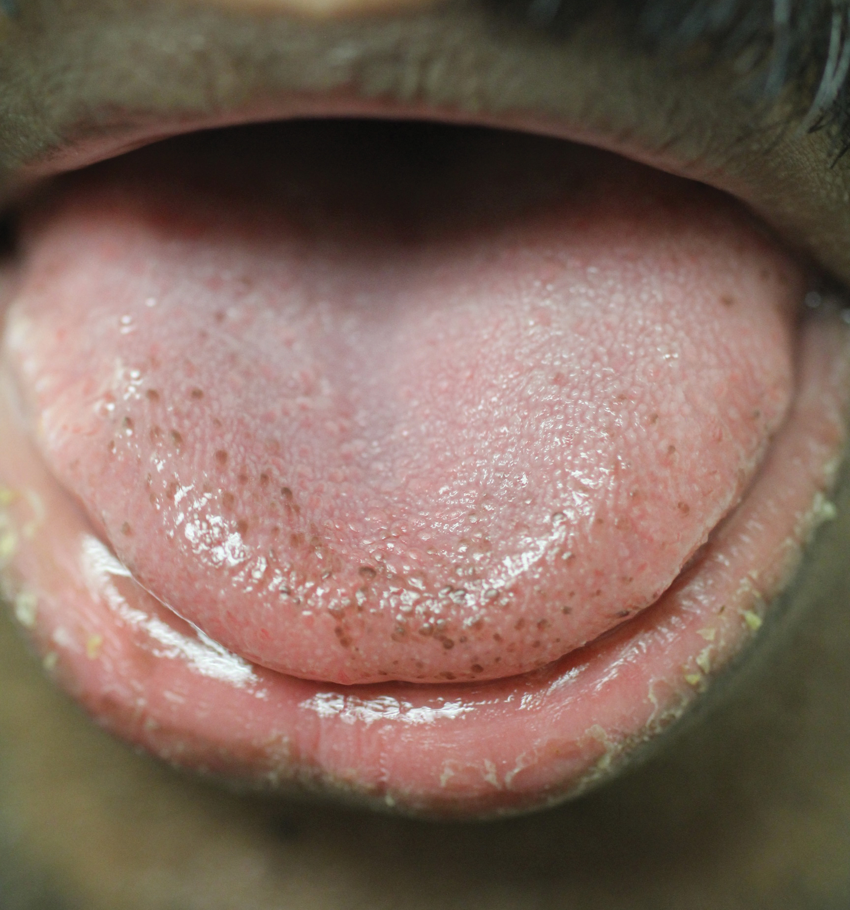 Blood Spots On Tongue