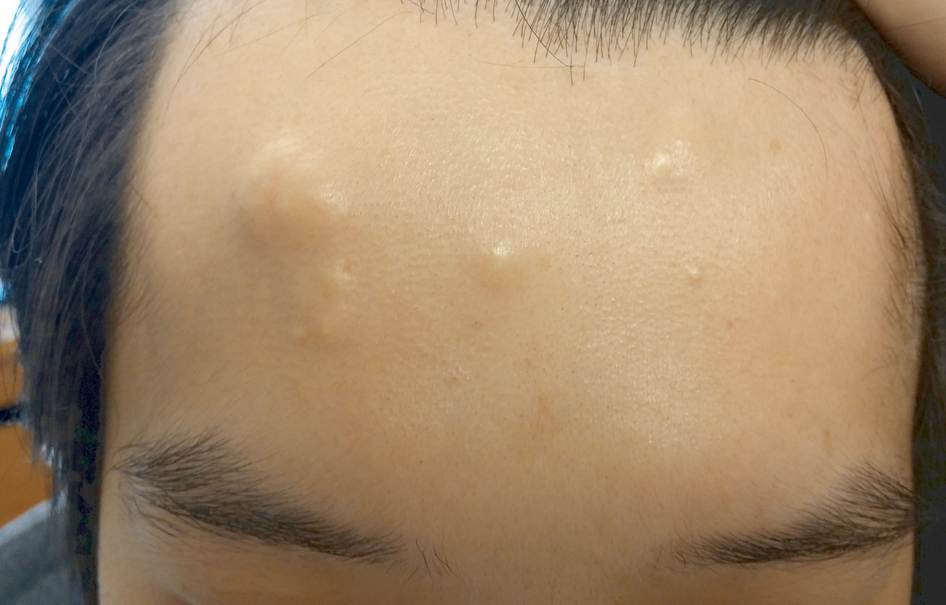 dermoid cyst on face