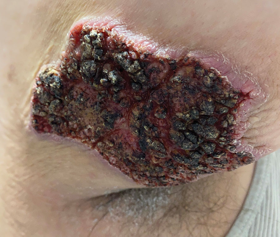 blastomycosis skin lesions