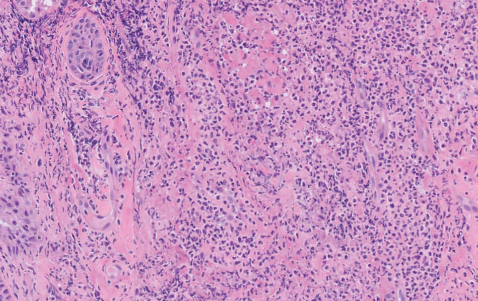 Histopathology showed a dense neutrophilic dermal infiltrate in the reticular dermis consistent with Sweet syndrome