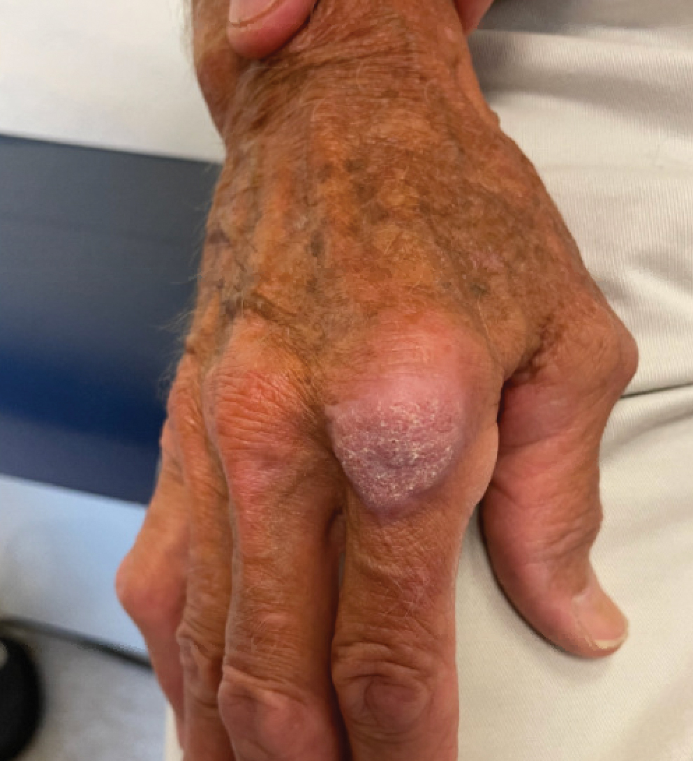 After 1 month of antibiotic treatment, the Mycobacterium marinum–infected lesion showed resolution of hyperkeratosis and overall improvement and regression.