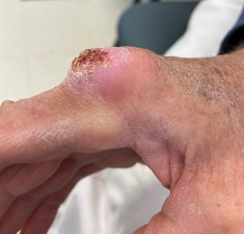 Atypical Keratotic Nodule on the Knuckle