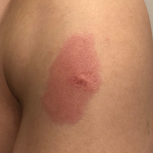 Erythema and induration surrounding a BCG vaccination scar on the deltoid muscle of the patient’s left arm 9 days after he received the first dose of the Moderna COVID-19 Vaccine