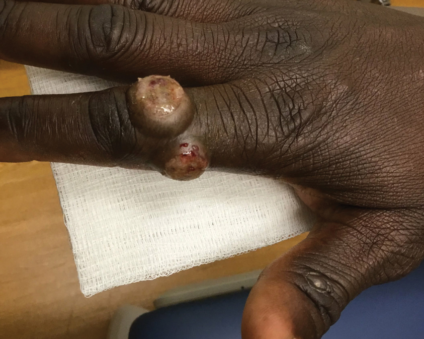 Two erythematous to yellowish, crateriform, exophytic nodules with secondary pustulation, central erosion, and serosanguineous drainage on the right second interphalangeal joint and proximal finger.