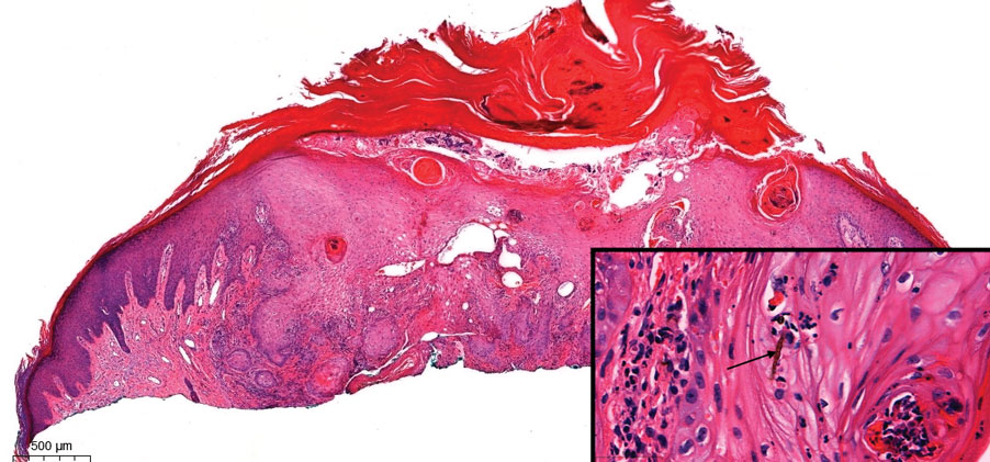 Pseudoepitheliomatous hyperplasia secondary to phaeohyphomycosis