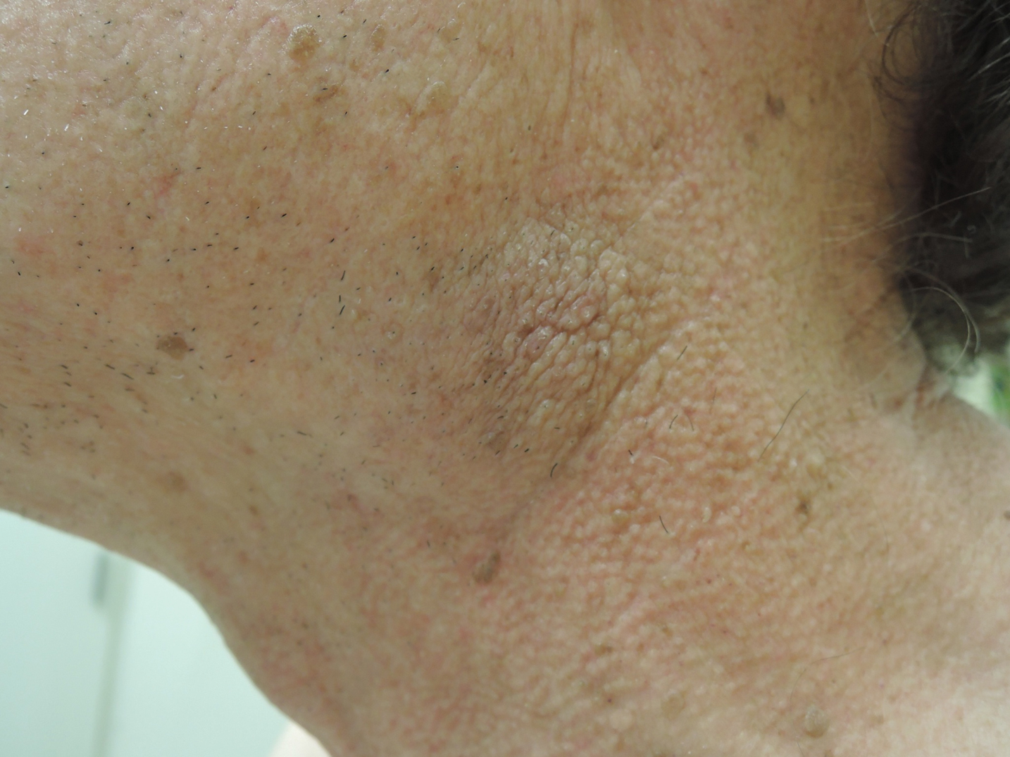 Minimally Hyperpigmented Plaque With Skin Thickening on the Neck