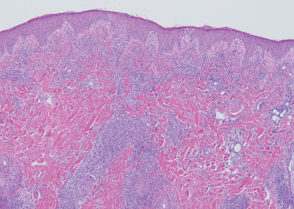 Lymphomatoid papulosis