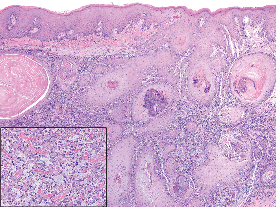 A well-differentiated squamous cell carcinoma with prominent keratinization with endophytic and expansile growth