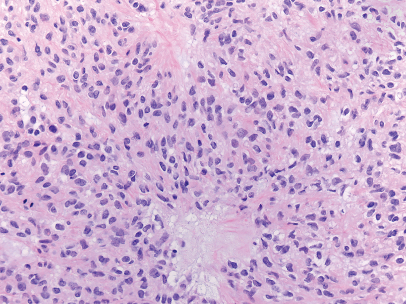 Myoepithelial carcinoma