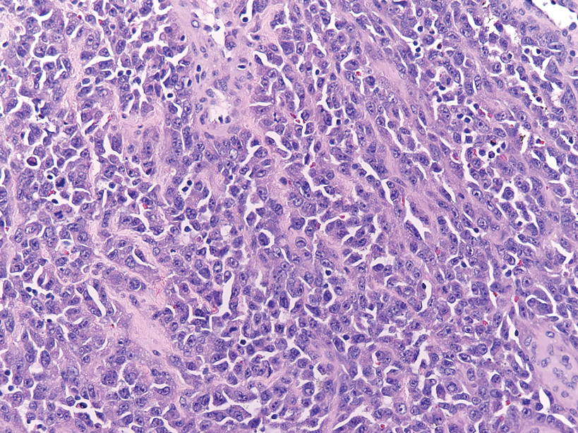 Angiosarcoma