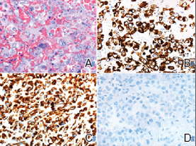 A: H&E, original magnification ×60; B: CAM5.2, original magnification ×40; C: vimentin, original magnification ×40; D: INI-1, original magnification ×40.