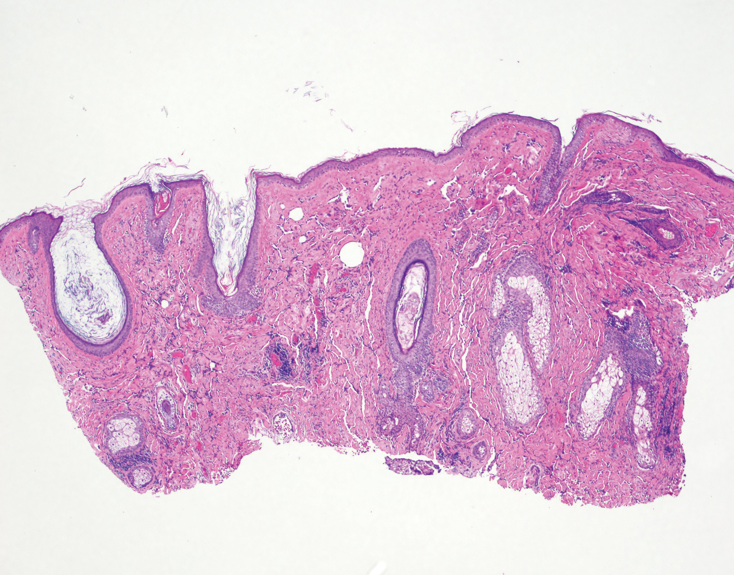 morpheaform basal cell carcinoma histology