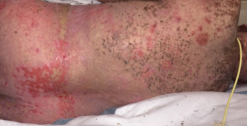 The rash evolved to full-thickness epidermal detachment within 48 hours