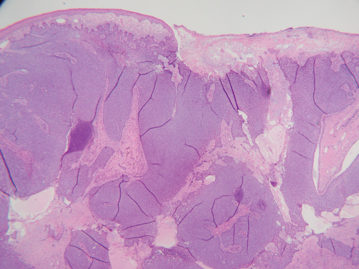 Fungating Mass On The Abdominal Wall Mdedge Dermatology