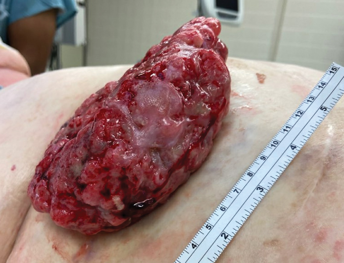 Fungating mass on the abdominal wall