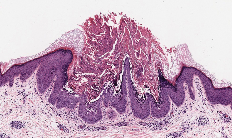Reticular Hyperpigmentation With Keratotic Papules in the Axillae