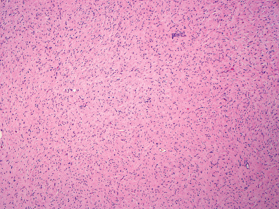 Neurofibroma. Interlacing bundles of elongated cells with comma-shaped nuclei are seen on a background of variably sized collagen bundles where the stroma contains mucin and interspersed mast cells (H&E, original magnification ×10).