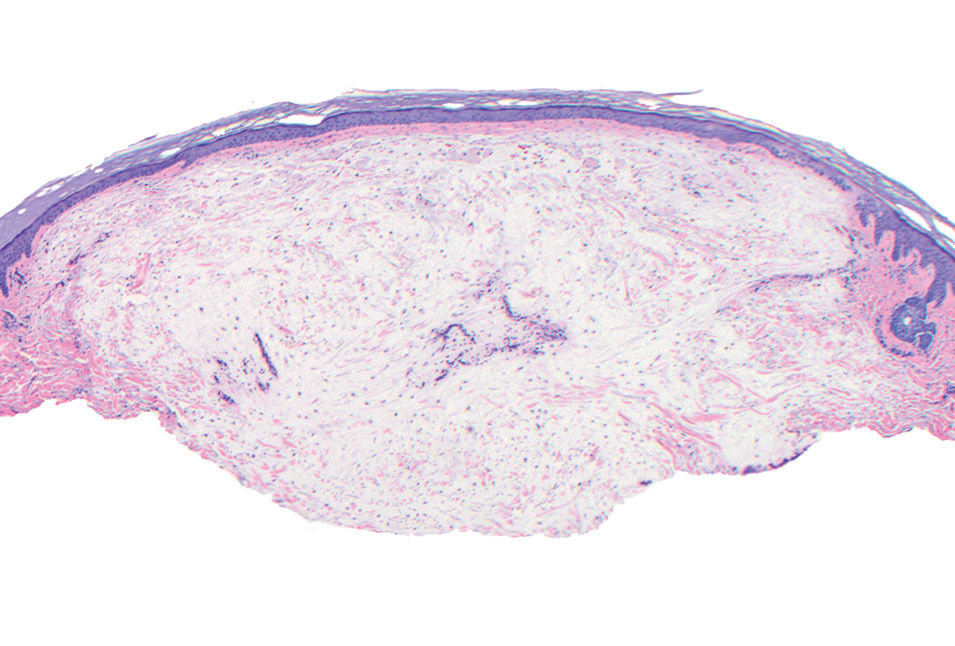 Focal cutaneous mucinosis. An isolated dome-shaped lesion with a focal, circumscribed, dermal pool of mucin and surrounding dermis with slightly increased fibroblasts (H&E, original magnification ×4).