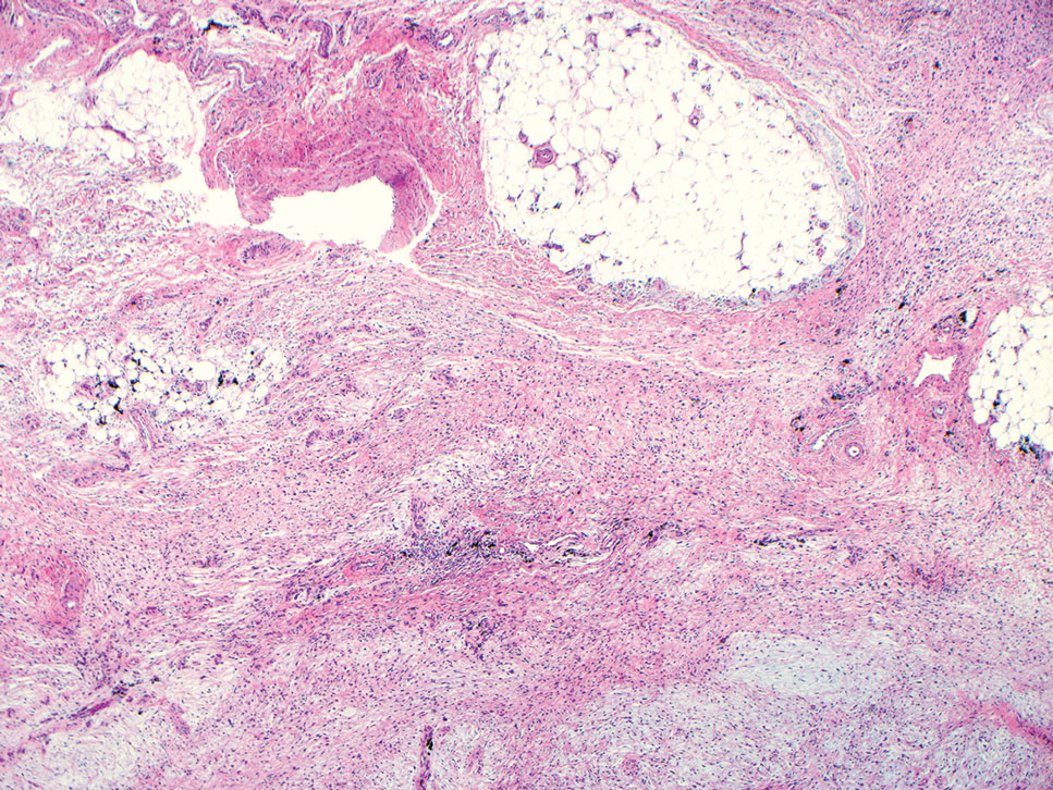 Myxofibrosarcoma. A lobulated tumor with a mixture of hypocellular and hypercellular areas with incomplete fibrous septae. Cells with atypical nuclei and pleomorphism with occasional multinucleated giant cells also are seen